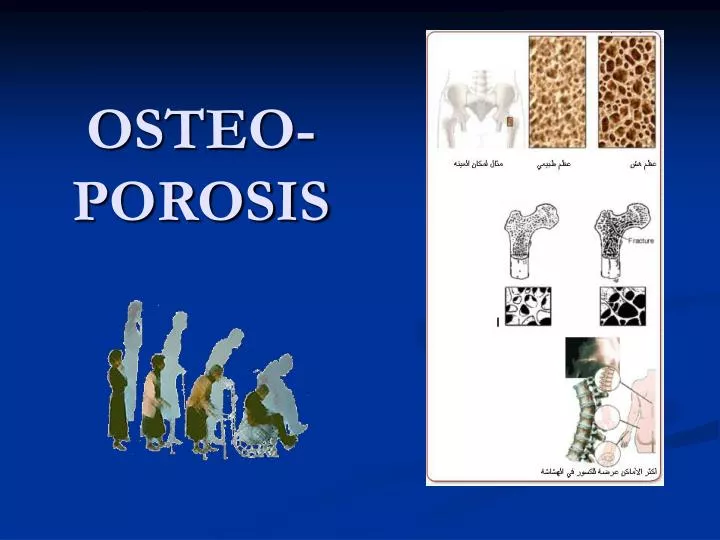 osteo porosis