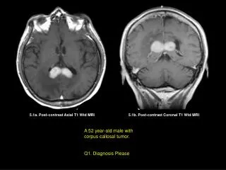5.1b. Post-contrast Coronal T1 Wtd MRI