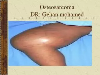 Osteosarcoma DR: Gehan mohamed
