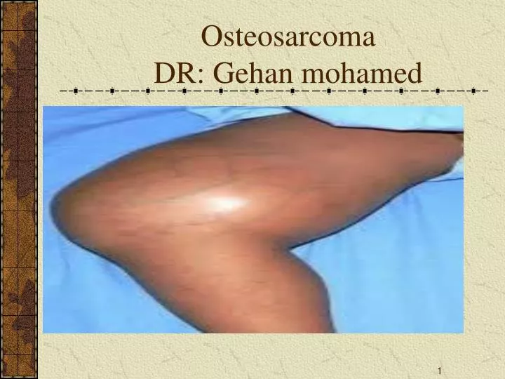 osteosarcoma dr gehan mohamed