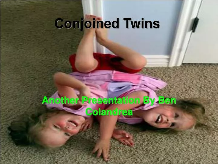 conjoined twins