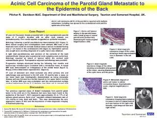 Acinic Cell Carcinoma of the Parotid Gland Metastatic to the Epidermis of the Back