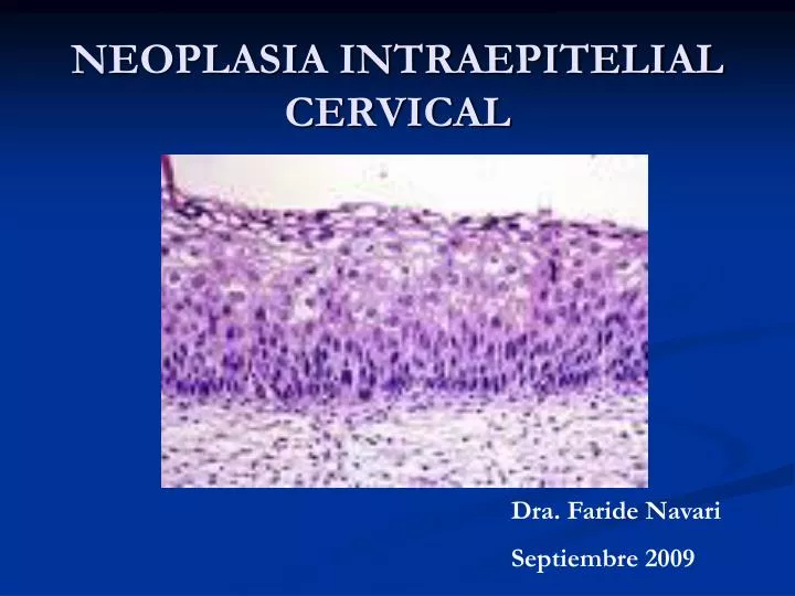 neoplasia intraepitelial cervical