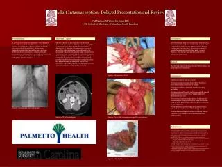 Adult Intussusception: Delayed Presentation and Review CM Watson MD and SA Fann MD USC School of Medicine, Columbia, Sou