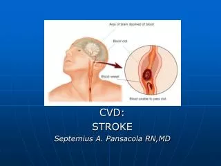 CVD: STROKE Septemius A. Pansacola RN,MD