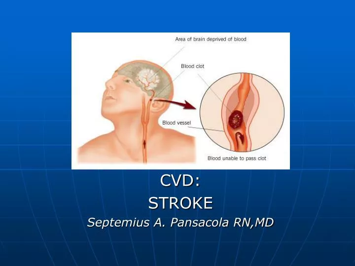 cvd stroke septemius a pansacola rn md