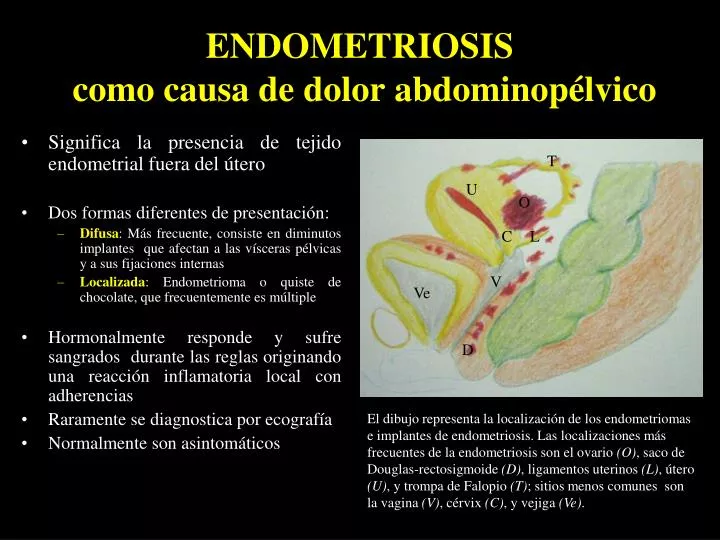 endometriosis como causa de dolor abdominop lvico