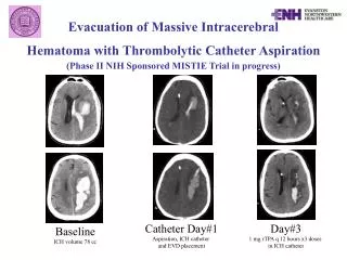 Evacuation of Massive Intracerebral Hematoma with Thrombolytic Catheter Aspiration (Phase II NIH Sponsored MISTIE Trial
