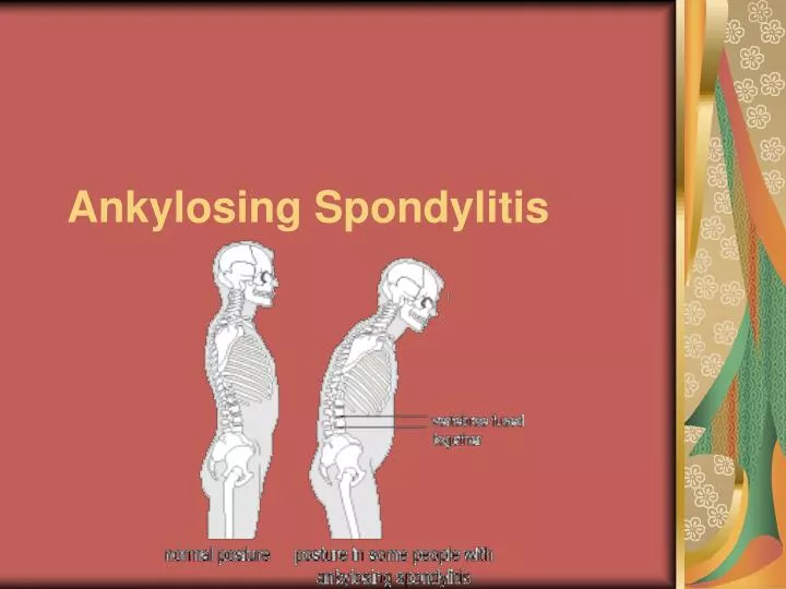 ankylosing spondylitis