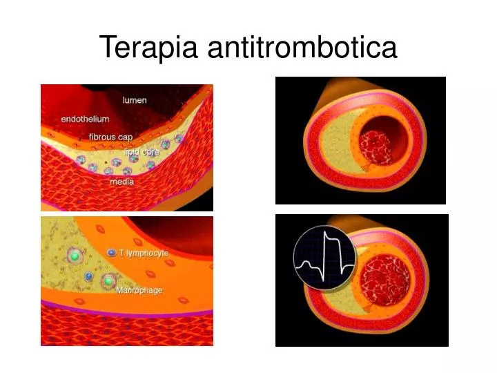 terapia antitrombotica