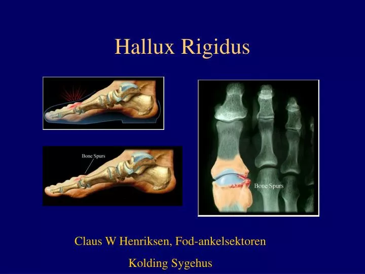 hallux rigidus