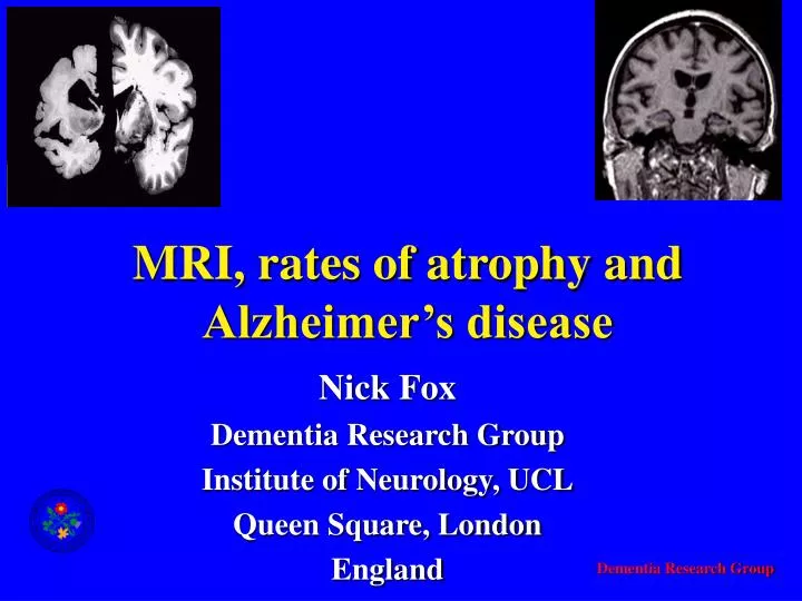 mri rates of atrophy and alzheimer s disease