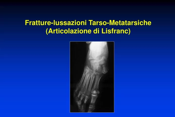 fratture lussazioni tarso metatarsiche articolazione di lisfranc