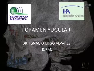 foramen yugular