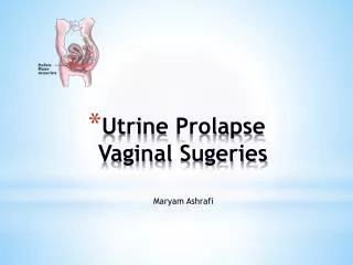 Utrine Prolapse Vaginal Sugeries