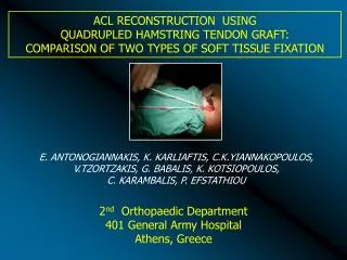 ACL RECONSTRUCTION USING QUADRUPLED HAMSTRING TENDON GRAFT: COMPARISON OF TWO T