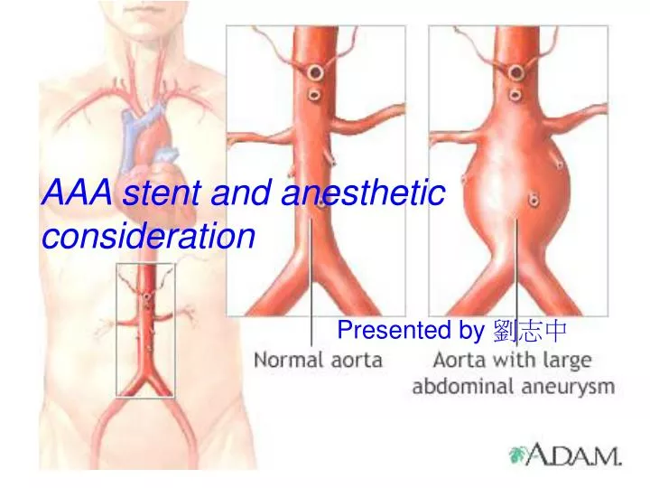 aaa stent and anesthetic consideration