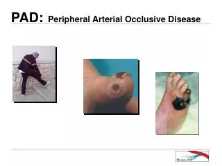 PAD: Peripheral Arterial Occlusive Disease