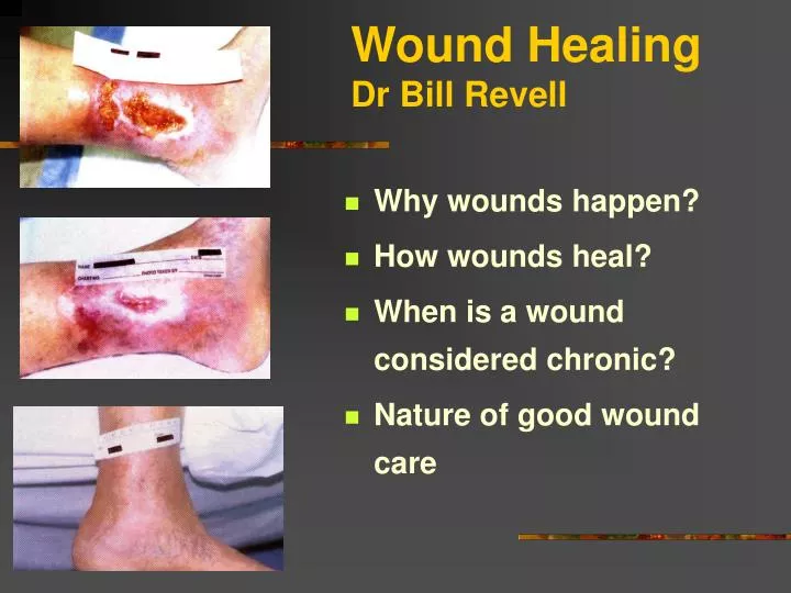 wound healing dr bill revell