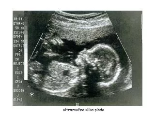 ultrazvučna slika ploda