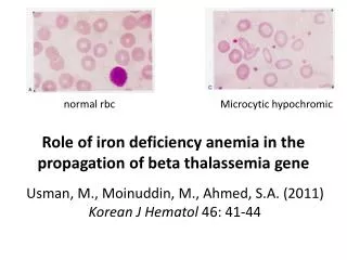 Role of iron deficiency anemia in the propagation of beta thalassemia gene