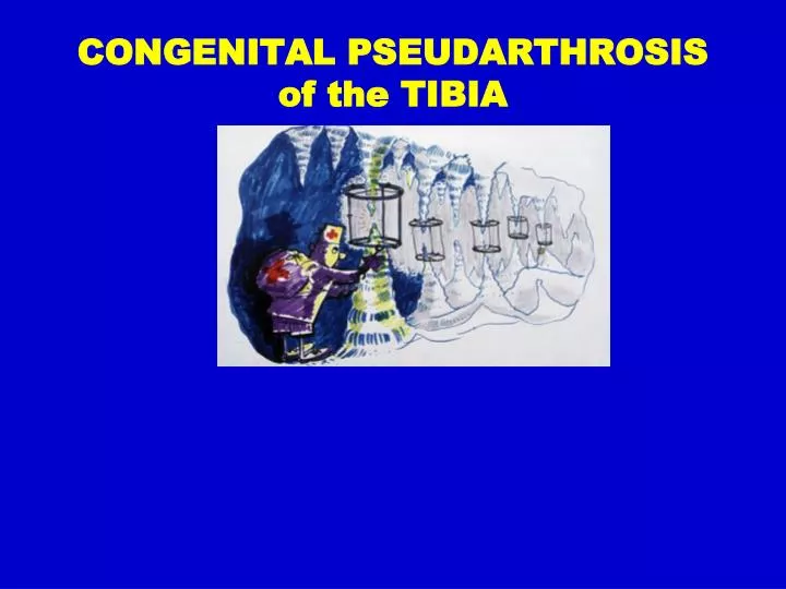 congenital pseudarthrosis of the tibia