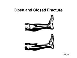 Open and Closed Fracture