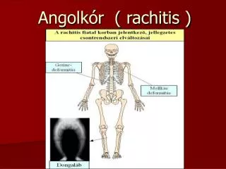 Angolkór ( rachitis )