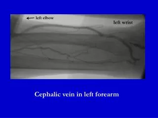 Cephalic vein in left forearm