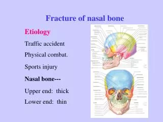Fracture of nasal bone Etiology Traffic accident Physical combat. Sports injury Nasal bone--- Upper end: thick Lower e