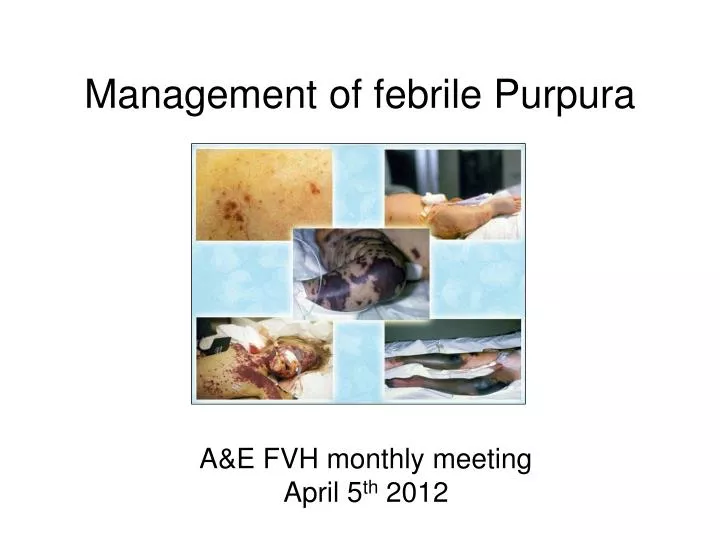 management of febrile purpura