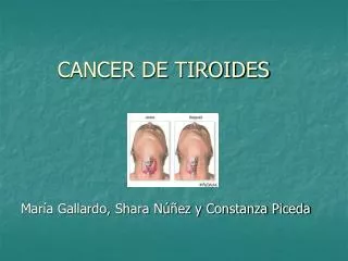 CANCER DE TIROIDES