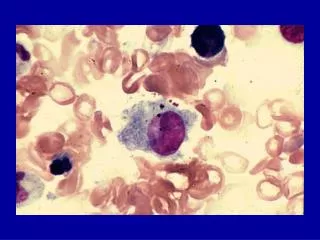 Histiocytic Syndromes