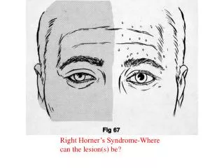 Right Horner’s Syndrome-Where can the lesion(s) be?