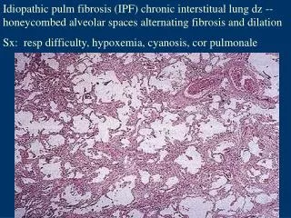 Idiopathic pulm fibrosis (IPF) chronic interstitual lung dz -- honeycombed alveolar spaces alternating fibrosis and dila