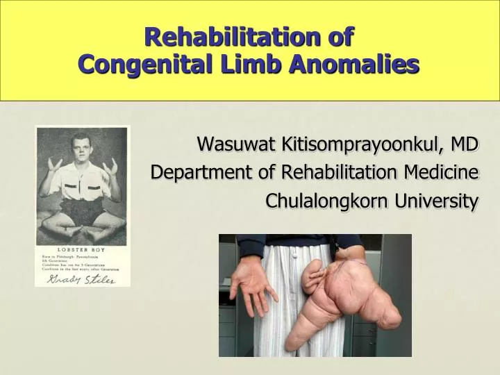 rehabilitation of congenital limb anomalies
