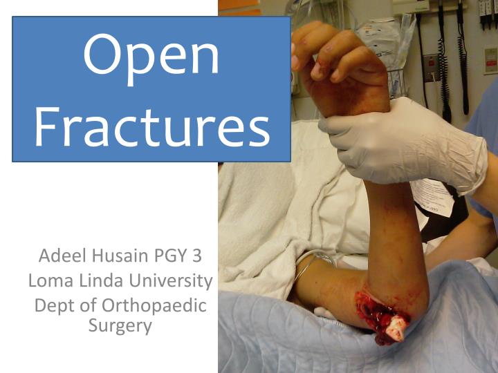 adeel husain pgy 3 loma linda university dept of orthopaedic surgery