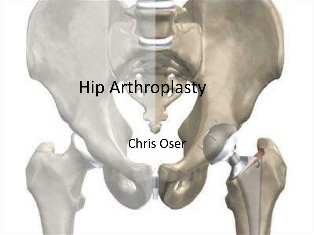 PPT - Hip Arthroplasty PowerPoint Presentation, free download - ID:1209827
