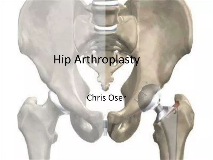 hip arthroplasty