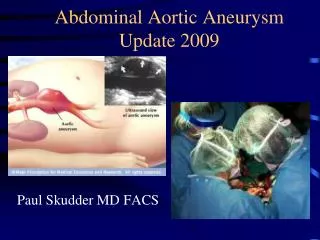 Abdominal Aortic Aneurysm Update 2009