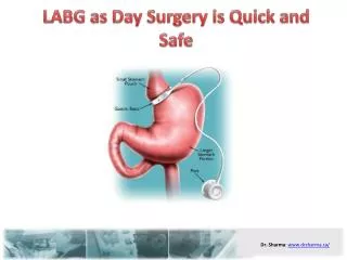 LABG as Day Surgery is Quick and Safe
