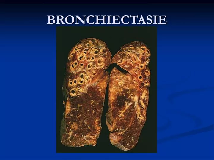 bronchiectasie