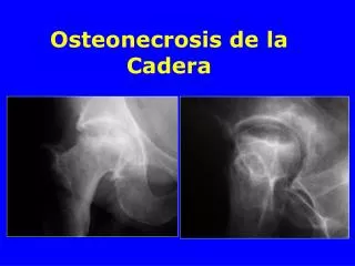 osteonecrosis de la cadera