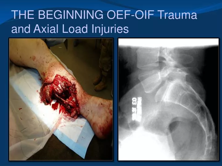 the beginning oef oif trauma and axial load injuries