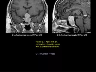 6.1a. Post-contrast coronal T1 Wtd MRI