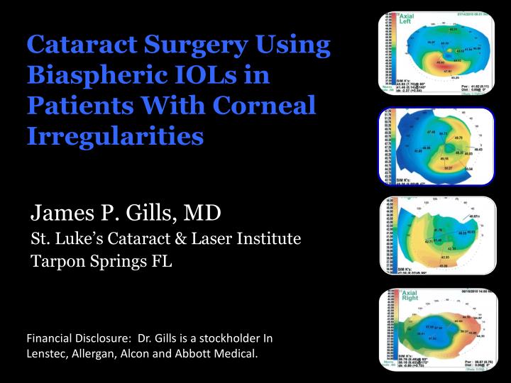 cataract surgery using biaspheric iols in patients with corneal irregularities