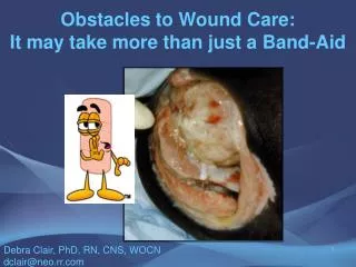 Obstacles to Wound Care: It may take more than just a Band-Aid