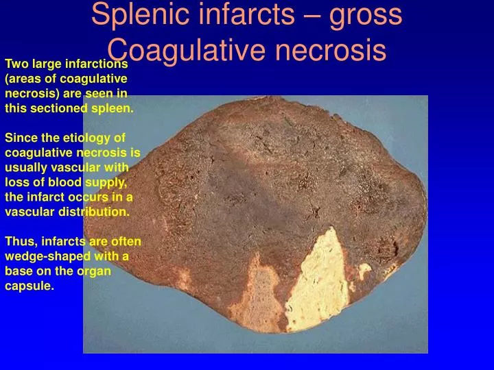 splenic infarcts gross coagulative necrosis