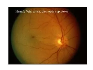 Identify Vein, artery, disc, optic cup, fovea