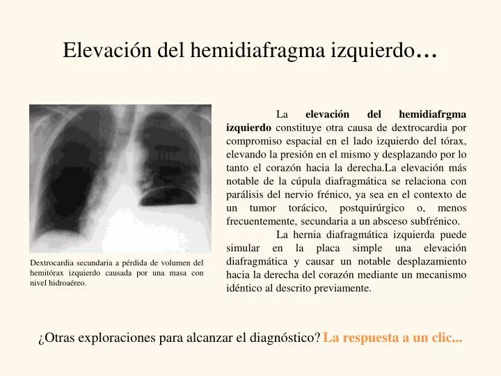 elevaci n del hemidiafragma izquierdo